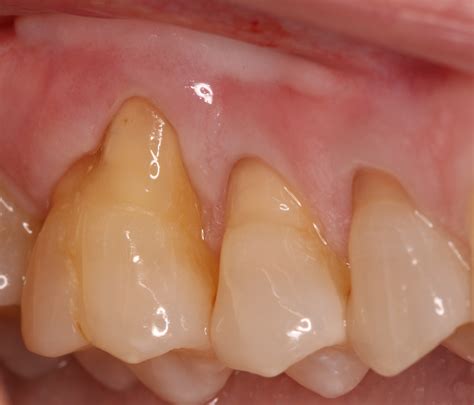 Gum Recession Treatment - Video - Ryan Lanman DDS, MSD