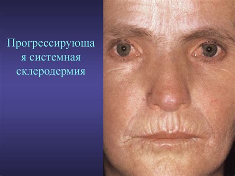 Системная Красная Волчанка Фото