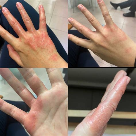 5 Signs Your Eczema Is Finally On The Mend