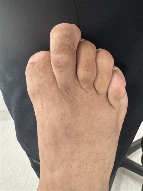 Mallet Toe Before and After Photos | Northwest Surgery Center