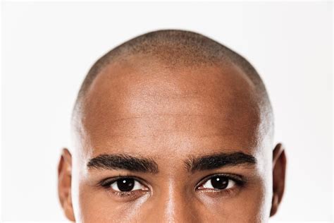 hair transplant  afro hair dental studio antalya