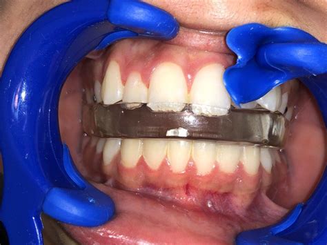 bite plate     ronald whitehurst blog