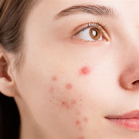 ACNE - Symptoms, Causes, Complications, and Treatment - Ecosh