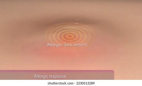 Allergic Reaction On Human Skin Stock Illustration 2230513289 ...