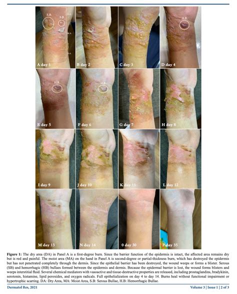 How To Care For Your Skin Through The Various Healing Process Stages Of A Wart Falling Off Safely 1