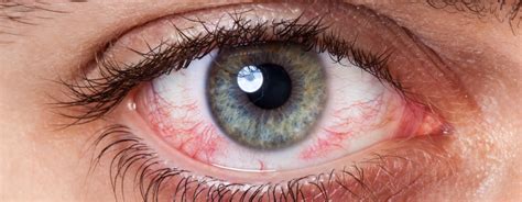O Que Causa Derrame Nos Olhos - Sangue nos olhos: 4 principais tipos e suas causas