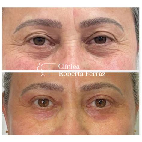 Blefaroplastia Sem Corte Antes E Depois - Blefaroplastia sem cortes e sem cirurgia - Rejuvenesça o seu olhar!