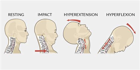 Whiplash - The Complete Injury Guide - Vive Health