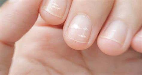 Linhas Brancas Na Unha - Leuconiquia: Manchas brancas nas unhas | White lines on nails, Lines on ...