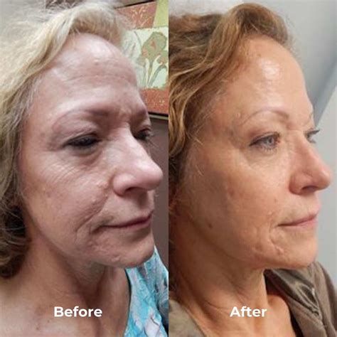 home microneedling before and after 11