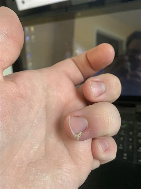 Here’s an ingrown fingernail for y’all. Merry Christmas! : r/popping