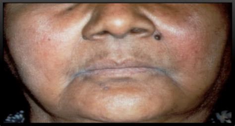 Sjogrens_Syndrome Flashcards | Quizlet