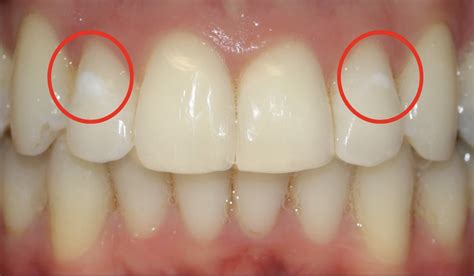 understanding dental cavities  prevention