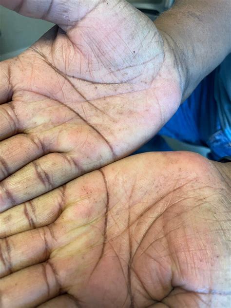 Dermatologic Look-Alikes: Spiny Bumps - Clinical Advisor