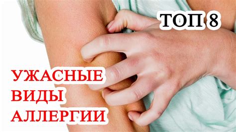 Топ 8 Самые необычные виды аллергии в мире. Ужасные причины аллергии ...
