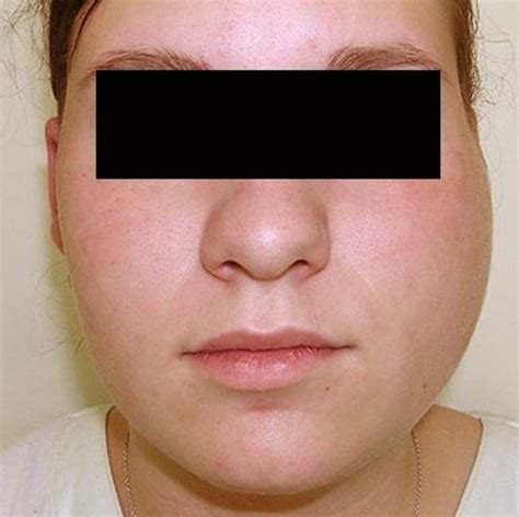 Parotitis - Symptoms, Causes, Treatment, and Pictures - HubPages