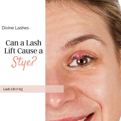 swollen eyelid treatment fast home remedy 4