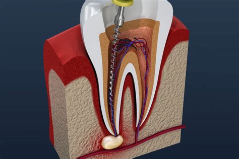 root canal  crown