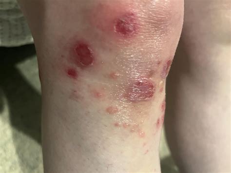 Impetigo or ringworm? : r/skin