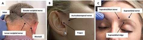 Posterior Auricular Nerve Block