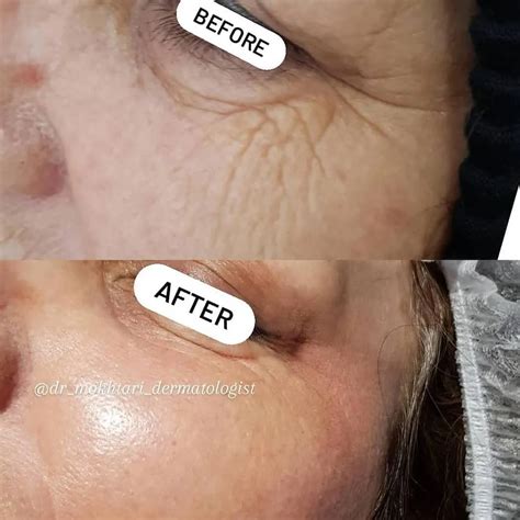 laser  wrinkles artofit