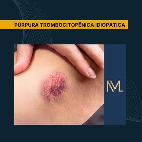 O Que Significa Idiopatica - Histologia Da Purpura Trombocitopenica Idiopatica Púrpura