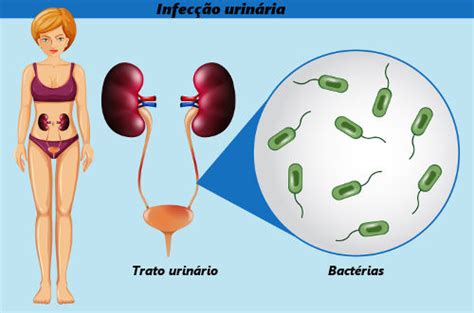 O Que Causa Infecção Urinária Na Mulher - Infecção urinária - Escola Kids