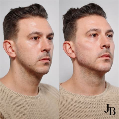 Jawline Filler London | Jawline Contouring | JB Aesthetics