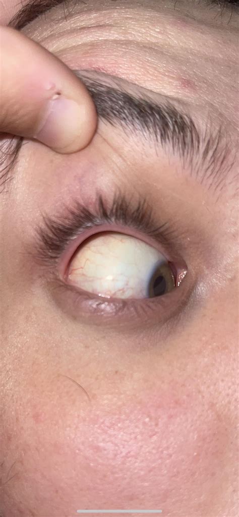 Kidney Infection. Eyes yellow? : r/medical_advice