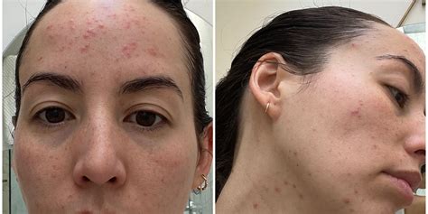 What Is Steroid Acne? Skin Tips From a Dermatologist | PS Beauty