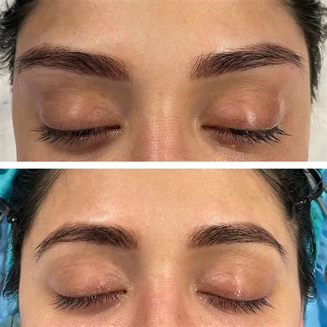 Cat-eye Surgery: Procedure, Providers, Photos | Belorens