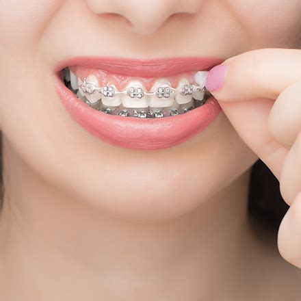 braces anatomica clinic anatomica clinic