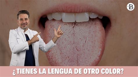 por  tengo la lengua blanca  de otro color youtube