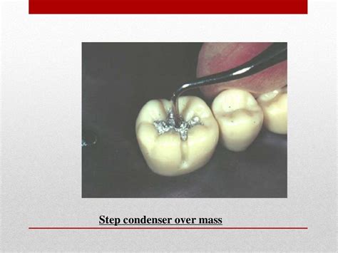procedure for amalgam restoration