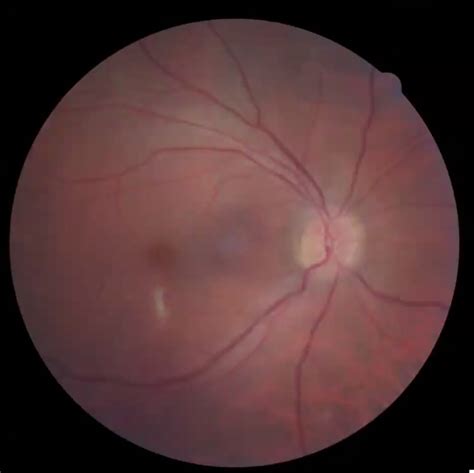 The Great Imitator: Retinal Manifestations of Ocular Syphilis