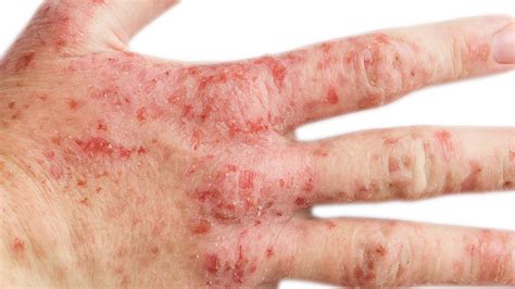 Atopic Dermatitis (eczema)