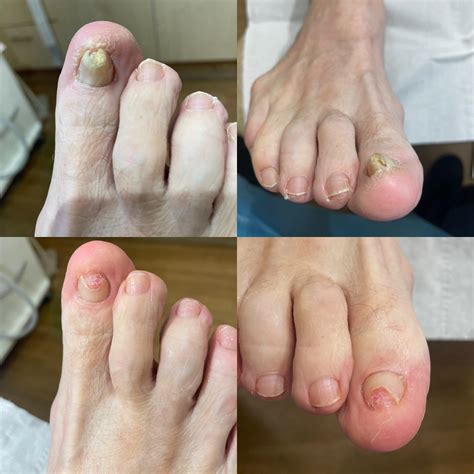 Rachel - Before and after pics of a severely involuted nail pinching