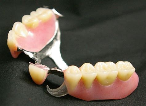 Types Of Removable Partial Denture Clasps at Brandon Premo blog
