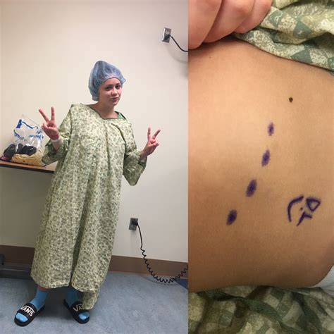 Pin by Lori Asaro on Nat's Surgery for Slipping Rib Syndrome | Slip