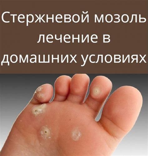 Стержневой мозоль лечение в домашних условиях | Полезные альтернативные ...
