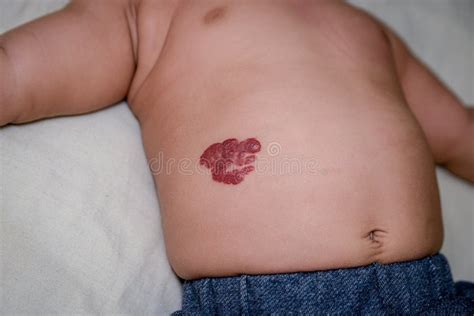 Marca De Nascença Vermelha - Marca De Nascença Vermelha Do Hemangioma Infantil Na Barriga Do ` S Do ...