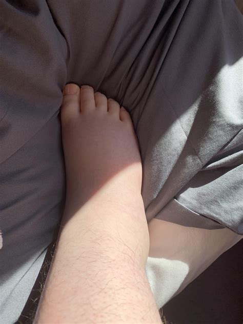 Permanently swollen ankle/foot : r/medical
