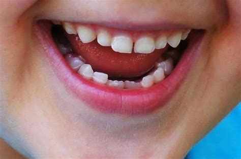 Пляшковий карієс ️ Лікування пляшкового карієсу | MySmile®