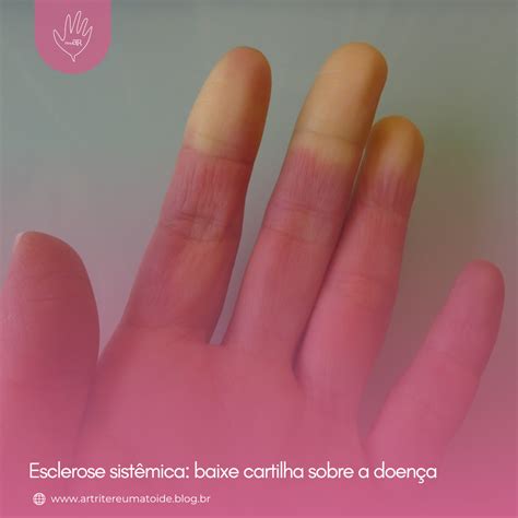 O Que Esclerose Sistemica - Esclerose Sistêmica - Artrite Reumatóide