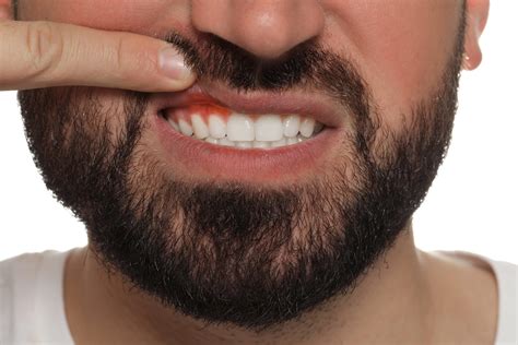 Gum Abscess Treatment | Pearl Dental Clinic