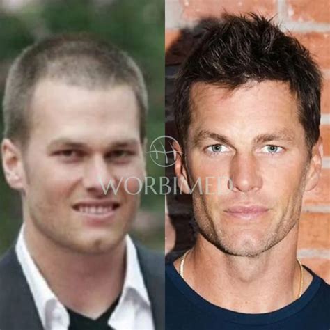 Tom Brady Hair Transplant l Before and After