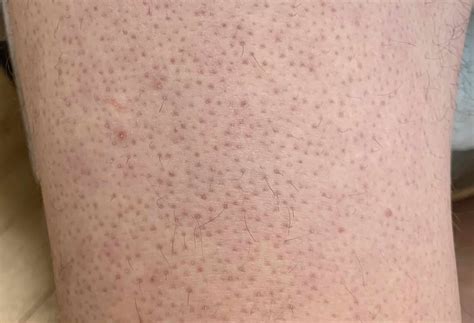 Keratosis Pilaris Rubra Faceii vs Rosacea - Baiden Mitten 2025