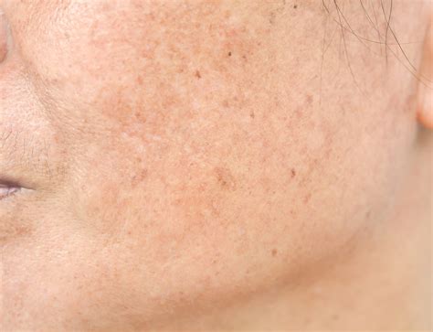 YAG Laser Skin Treatment in NY, NJ and CT
