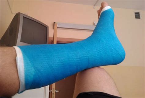 Реабилитация после перелома лодыжки после снятия гипса