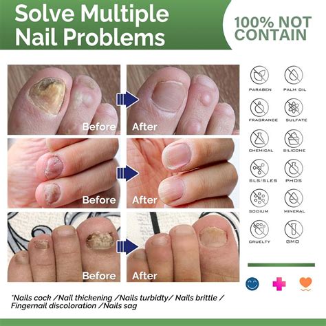 Healthy Nail Formula - Toenail Fungus Treatment & Repair Solution for